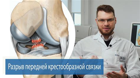 Лечение разволокнения передней крестообразной связки - методы и процедуры