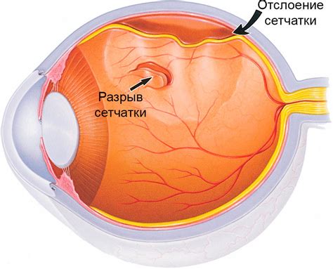 Лечение разрежения сетчатки