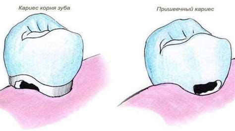 Лечение расширения корня легкого у детей