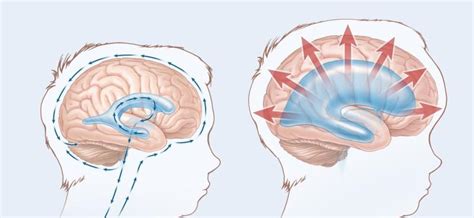 Лечение расширения субарахноидального пространства