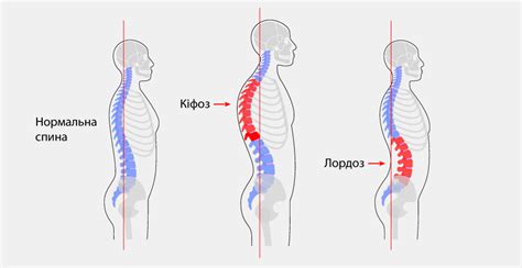 Лечение сглаженного кифоза