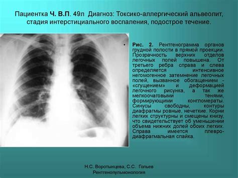 Лечение сгущения легочного рисунка слева