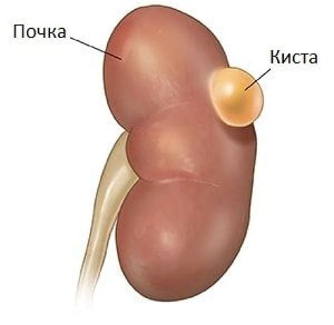 Лечение синусных кист почек у взрослых женщин