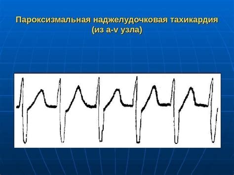 Лечение синусового ритма сердца