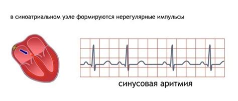 Лечение синусовой аритмии эос горизонтальной