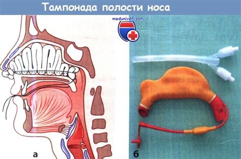 Лечение сколиозного носа у взрослых и детей