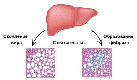 Лечение стеатогепатита умеренной степени активности