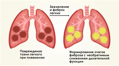 Лечение стекленеющих легких