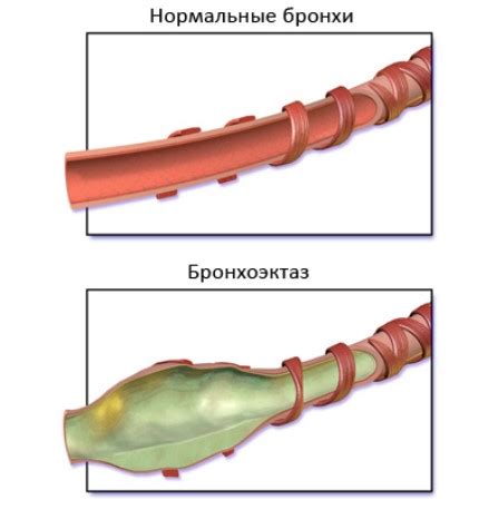 Лечение тубулярных бронхоэктазов