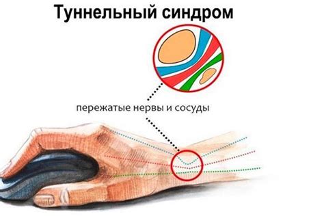 Лечение туннельной невропатии верхних конечностей