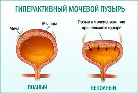 Лечение тура мочевого пузыря у мужчин