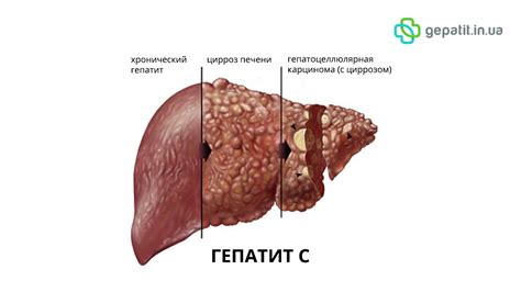 Лечение умеренной гепатомегалии у взрослых