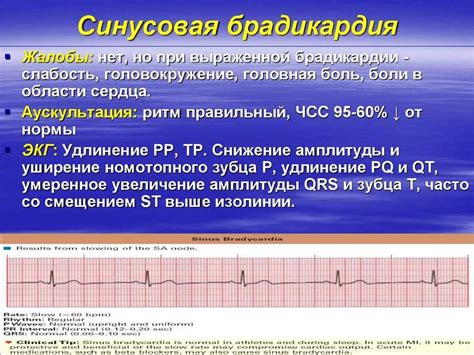 Лечение умеренной синусовой брадикардии