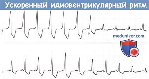 Лечение ускоренного нижнепредсердного ритма