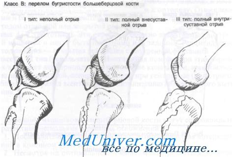 Лечение фрагментации бугристости большеберцовой кости