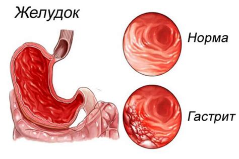 Лечение хронического гастрита вне обострения