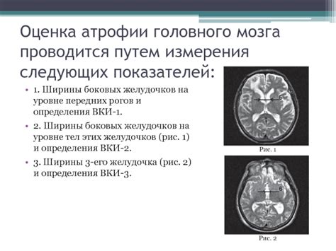 Лечение церебральной атрофии GCA 1