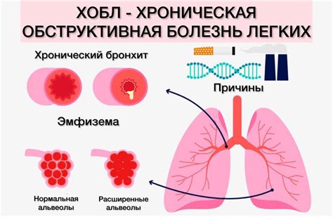 Лечение эмфизематозных изменений легких