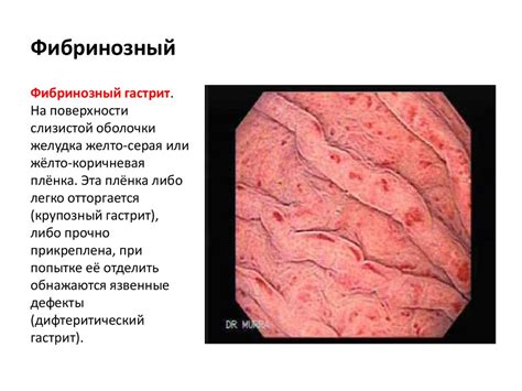 Лечение эрозий пищевода под фибрином: методы и препараты