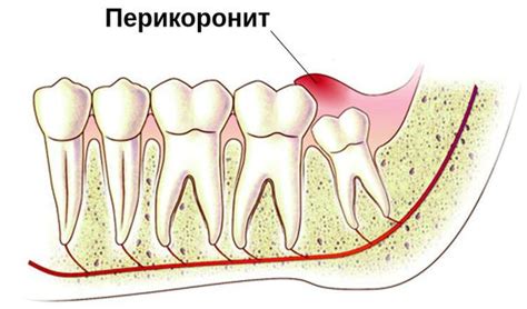 Лихоманка: симптомы, причины и лечение