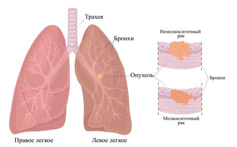 Лобэктомия легкого - основные аспекты и процедура операции