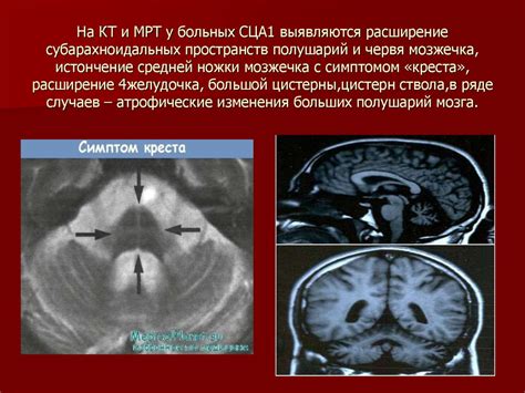 Локальное расширение субарахноидального пространства