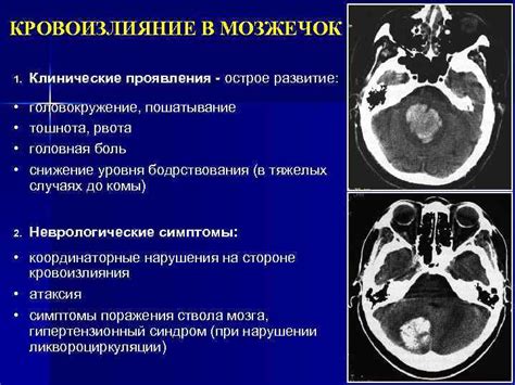 Лопнул мозжечок: причины и симптомы