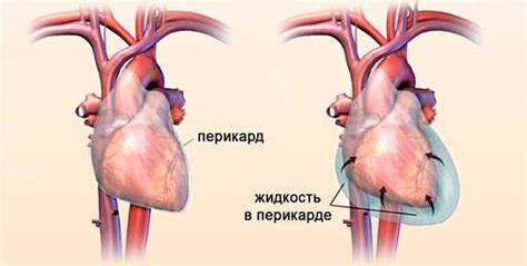 Малый гидроперикард легких: основные причины