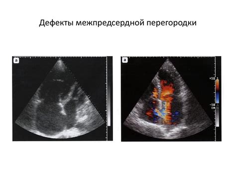 Материальные дефекты перегородки