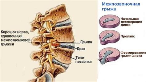 Медианная протрузия диска