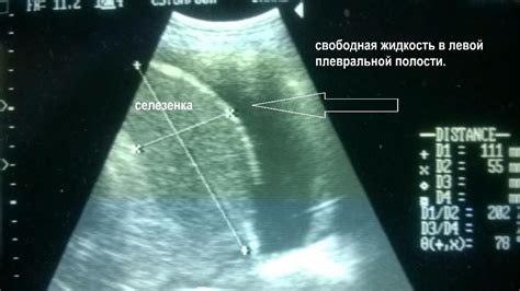 Медикаментозное лечение завуалирования плевральных синусов