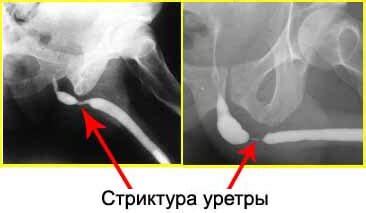 Медикаментозное лечение расширения уретры