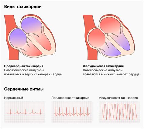 Медицинские причины повышенного пульса