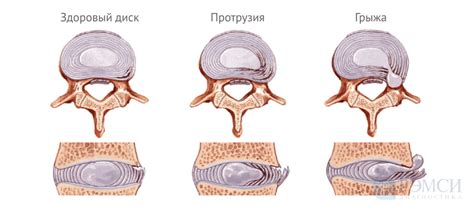 Межпозвоночная грыжа и мурашки в одной ноге