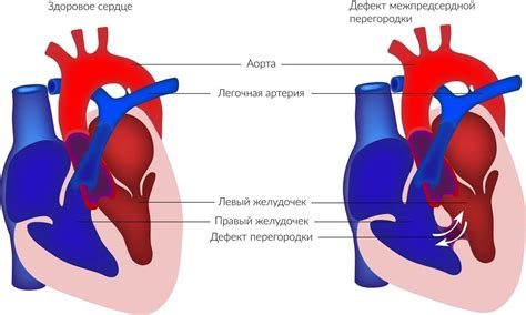 Межпредсердное сообщение у новорожденного