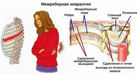 Межреберная невралгия: что это?