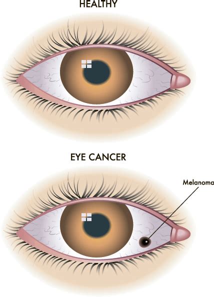 Меланома глаза: симптомы, лечение, профилактика