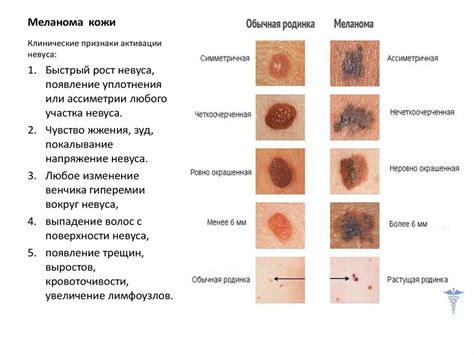 Меланома и пигментные пятна