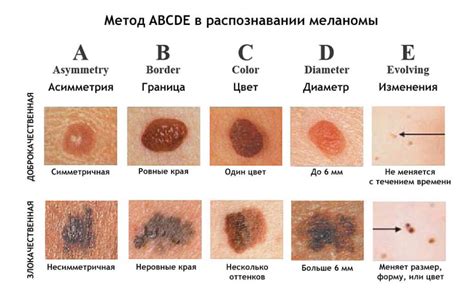 Меланома кожи: опасное заболевание смертельного исхода