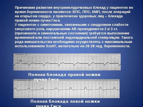 Местная внутрижелудочковая блокада