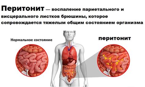 Местный перитонит: основные симптомы и признаки