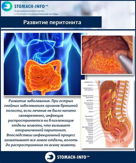 Местный перитонит: терапевтическая тактика и оперативное вмешательство