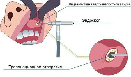 Методы анализа и лечения проблем с пневматизацией основной пазухи