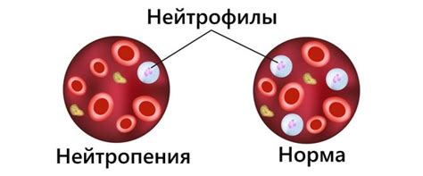 Методы диагностики и лечения нейтропении