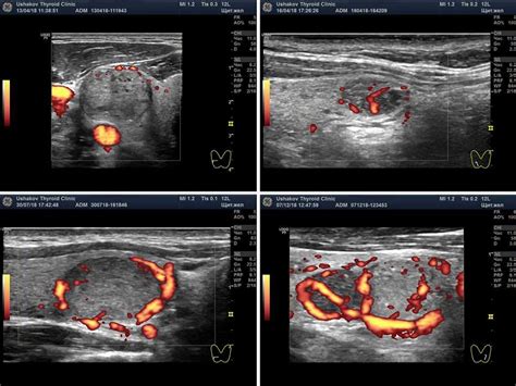 Методы диагностики и лечения увеличенного кровотока щитовидной железы