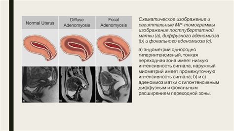 Методы диагностики и распределения признаков диффузного аденомиоза