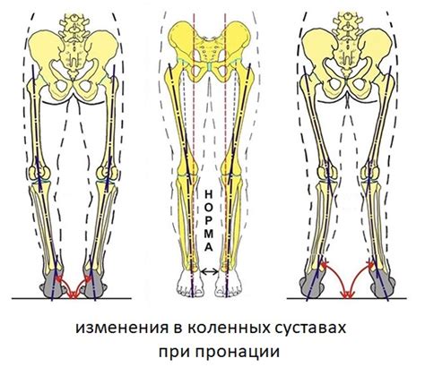 Методы коррекции избыточной пронации: упражнения и специальная обувь