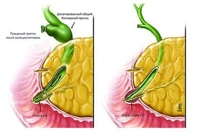 Методы лечения дисфункции сфинктера одди