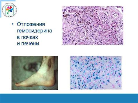 Методы лечения и удаления очагов отложения гемосидерина