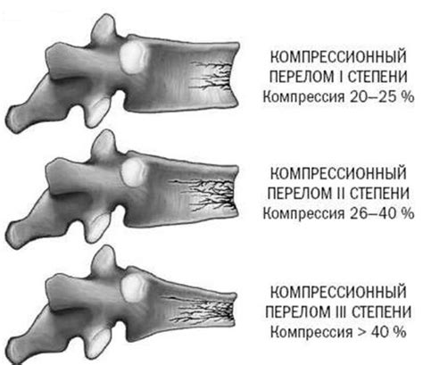 Методы лечения консолидируемого перелома